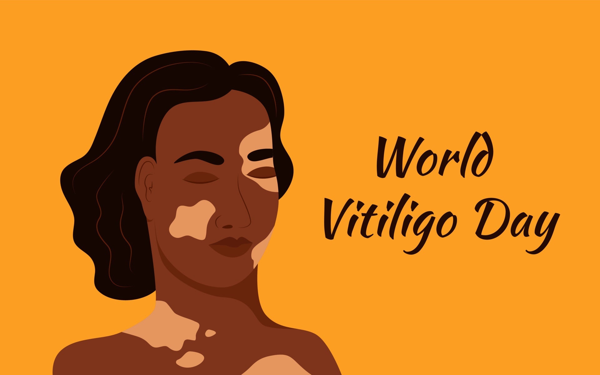 Wereld Vitiligo Dag: meer aandacht voor een zichtbare huidaandoening